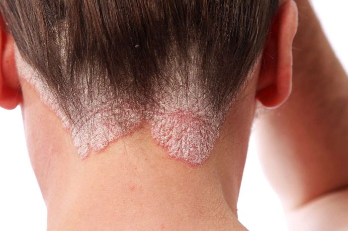 Dr Nassim Zaamouche : Quelle est la cause du psoriasis ?
